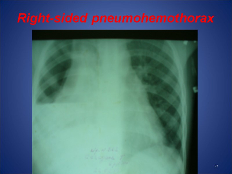 Right-sided pneumohemothorax  27